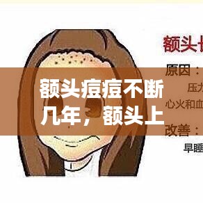 额头痘痘不断几年，额头上长痘痘好几年是什么原因引起的 