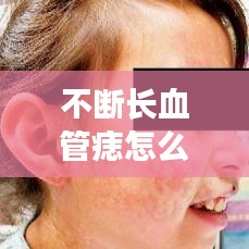 不断长血管痣怎么办？了解、应对与预防全攻略！