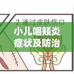 小儿咽颊炎症状及防治，百度权威解答！
