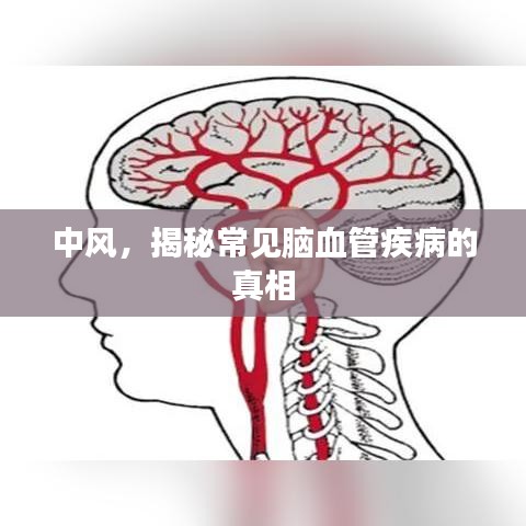中风，揭秘常见脑血管疾病的真相